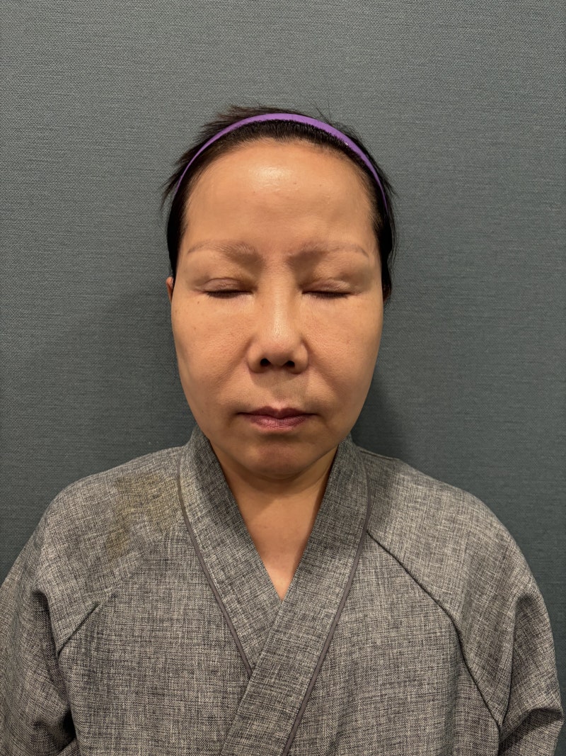 쌍꺼풀 재수술, 소세지눈 쌍꺼풀 낮추기 방법과 수술 후기 사진 2