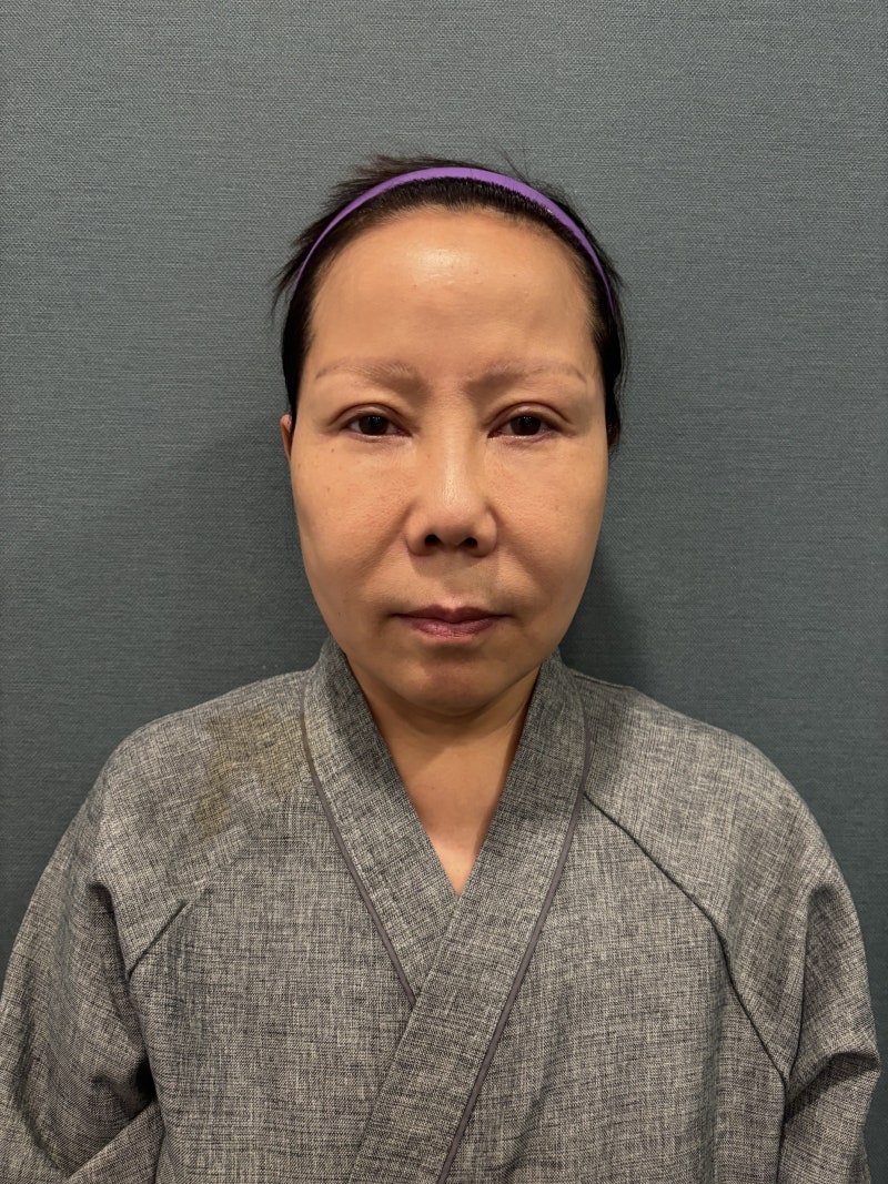 쌍꺼풀 재수술, 소세지눈 쌍꺼풀 낮추기 방법과 수술 후기