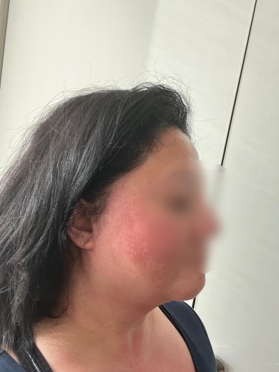 강남실리프팅 잘하는곳 찾는 방법과 대표원장이 말하는 추천 유형 사진 9