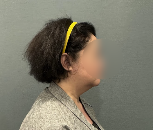 강남실리프팅 잘하는곳 찾는 방법과 대표원장이 말하는 추천 유형 사진 8