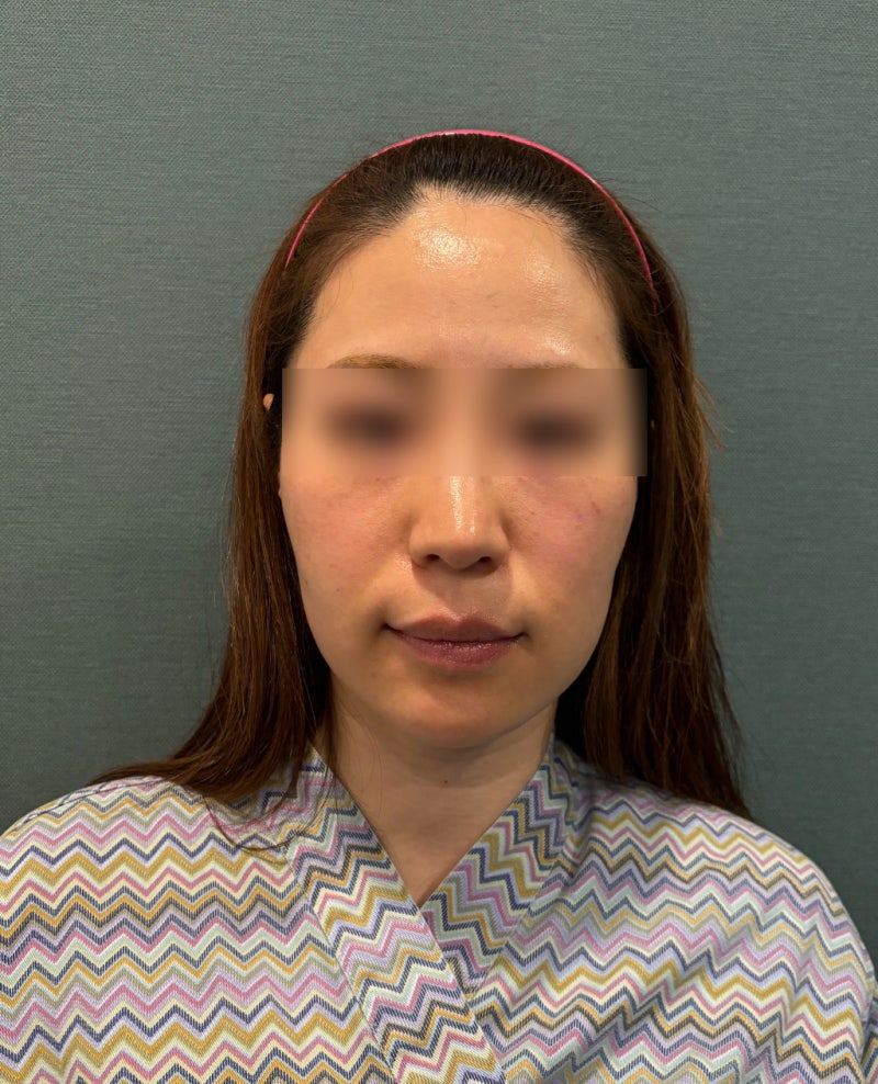 신논현역성형외과 실리프팅, 효과는 얼마나 가고 자연스러움은 어떻게 다를까 사진 6