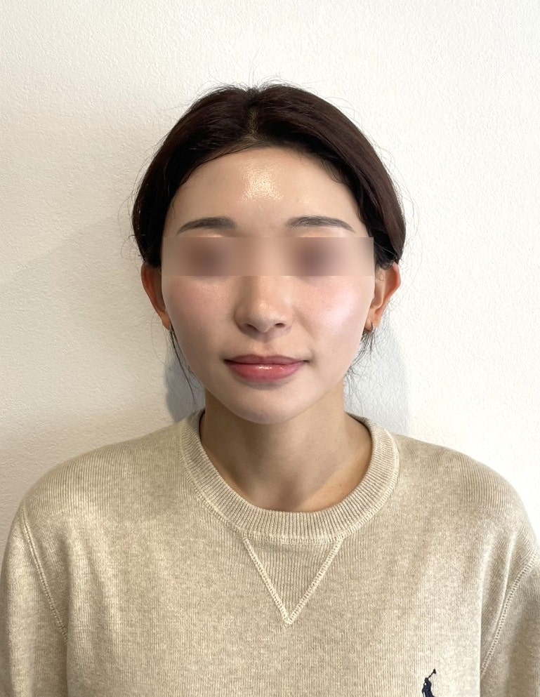 신논현역성형외과 실리프팅, 효과는 얼마나 가고 자연스러움은 어떻게 다를까 사진 9