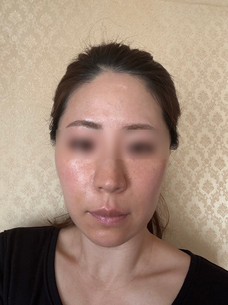 신논현역성형외과 실리프팅, 효과는 얼마나 가고 자연스러움은 어떻게 다를까 사진 7