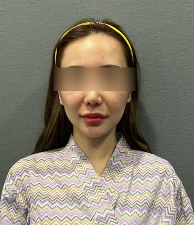 서울실리프팅추천받기 전 알아야 할 것들 — 부작용과 전문병원 기준 사진 9