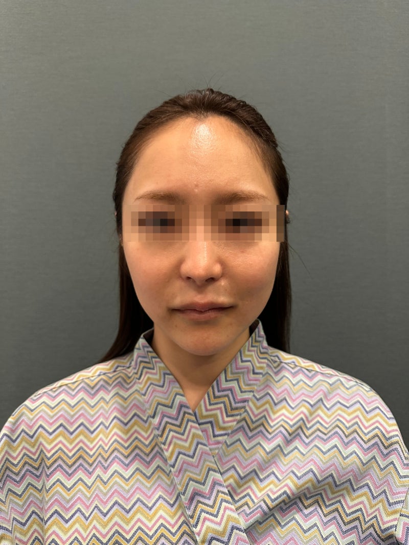 서울실리프팅추천받기 전 알아야 할 것들 — 부작용과 전문병원 기준 사진 3
