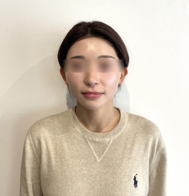 강남실리프팅가격 왜 다를까? 시술 방식과 진료 기준에서 보는 차이 사진 5