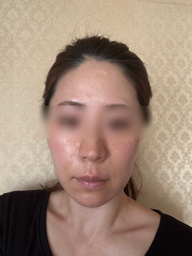 강남실리프팅잘하는병원 고민될 때, 이것부터 확인해 보세요 사진 6