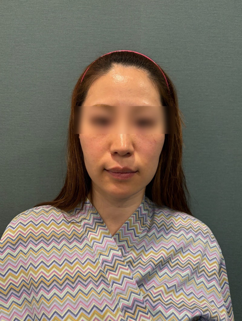 강남실리프팅잘하는병원 고민될 때, 이것부터 확인해 보세요 사진 5