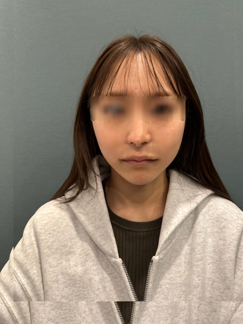 강남역성형외과유명한곳 추천 기준으로 보는 실리프팅, 동안 이미지는 어떻게 달라질까 사진 6