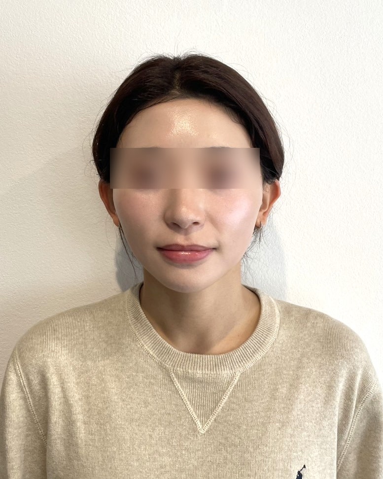 서울실리프팅 잘하는병원, 비용보다 설계 차이가 효과를 좌우합니다 사진 10