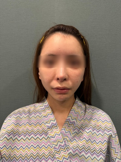 민트실리프팅 유지기간 효과 가격, 처짐이 있어도 과해 보이지 않게 하는 기준 사진 7