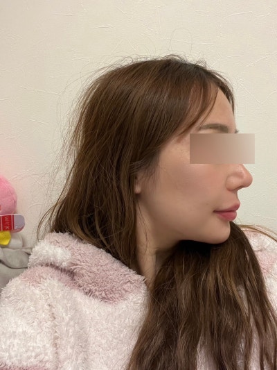 민트실리프팅 유지기간 효과 가격, 처짐이 있어도 과해 보이지 않게 하는 기준 사진 10