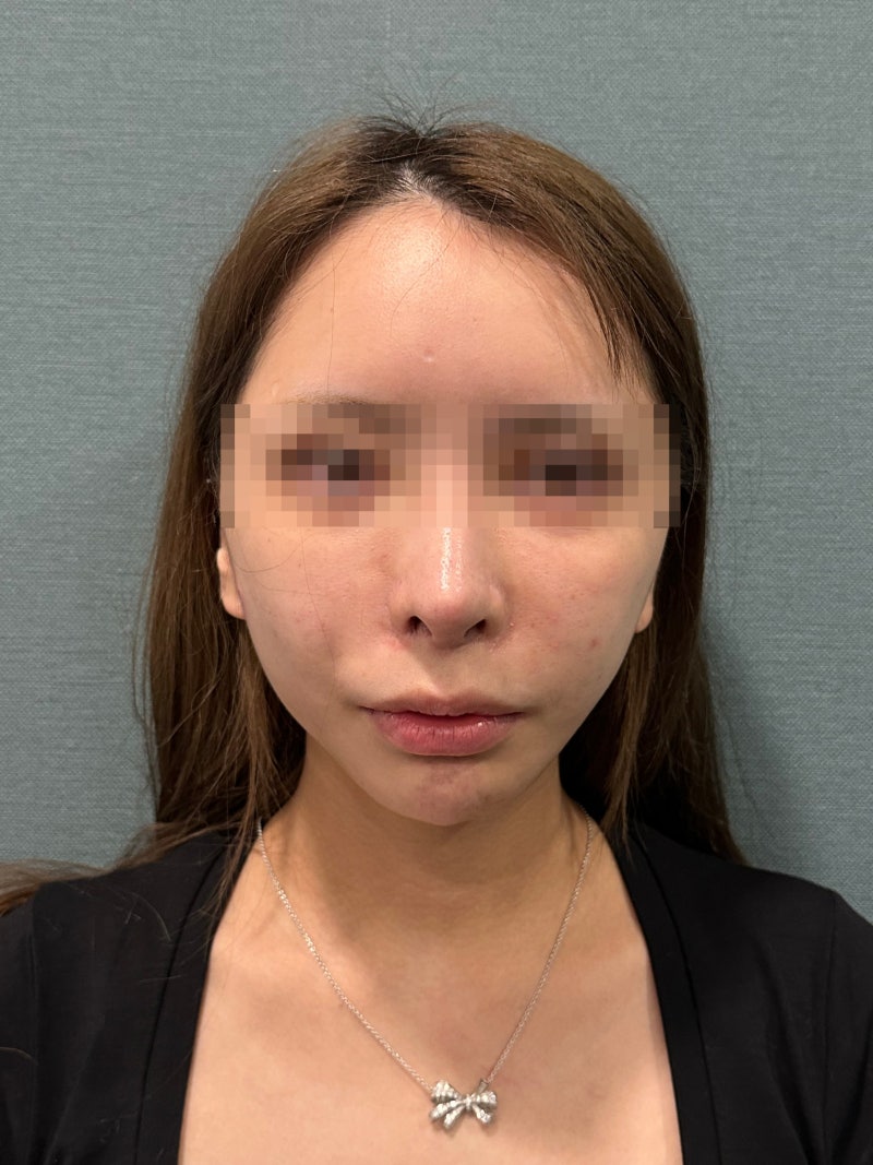 50대실리프팅, 처진 볼살·심부볼·팔자주름 연령별 효과 한 번에 정리 사진 5