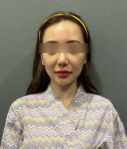강남실리프팅후붓기, 일상복귀는 언제 가능할까? 효과·멍·자연스러움까지 사진 8