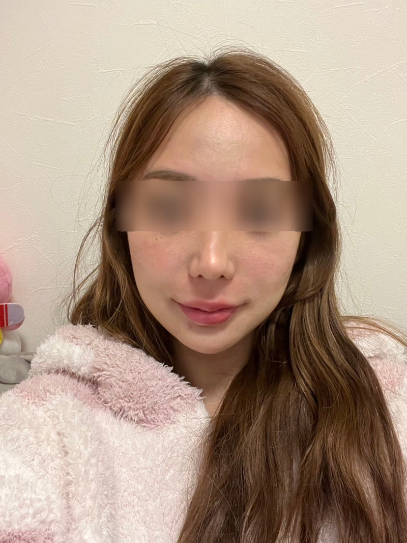 강남실리프팅후붓기, 일상복귀는 언제 가능할까? 효과·멍·자연스러움까지 사진 9