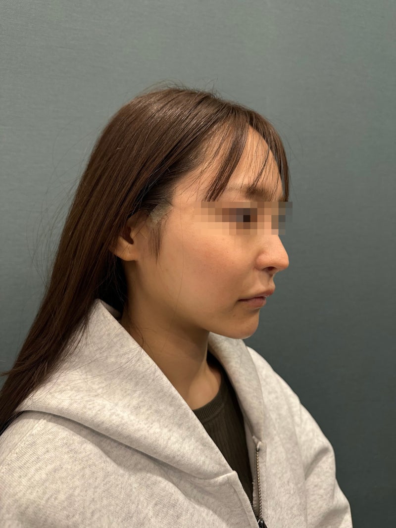 민트실리프팅부작용, 딤플·처짐이 생기는 원인과 자연스러움의 차이 사진 8