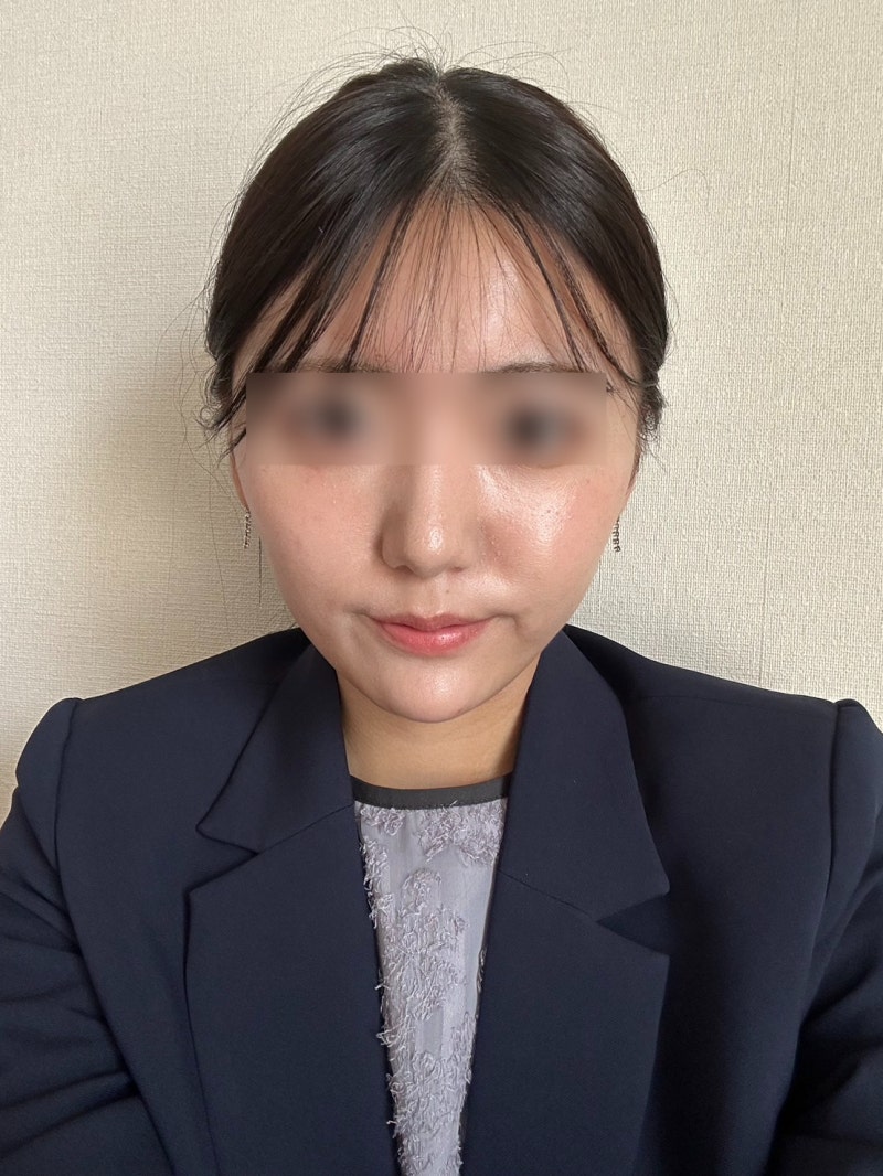 논현동성형외과 실리프팅 전 알아두면 좋은 멍·붓기·회복기간·유지기간 기준 사진 5