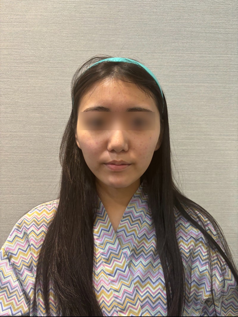 실리프팅멍, 회복기간은 얼마나 갈까? 붓기·자연스러움까지 강남성형외과 원장이 직접 알려드립니다 사진 5