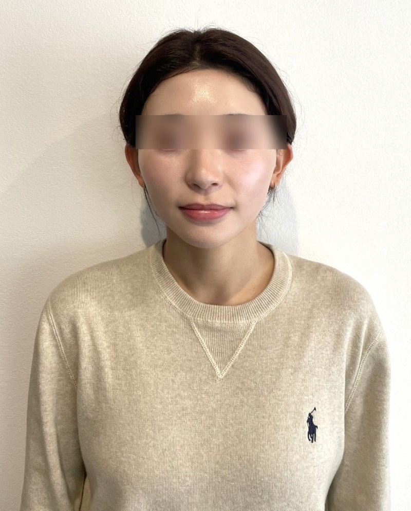 法令纹线雕种类,对「口角囊袋」和「深层脂肪垫下垂」有什么不同?疼痛·维持时间比较 사진 4