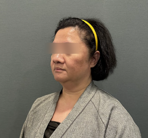 강남안면거상, 노화 걱정 앞두고 가장 많이 묻는 질문과 주의점 사진 4
