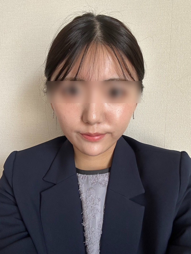 강남실리프팅 잘하는곳 선택 기준, 성형외과전문의가 설명하는 통증·붓기·멍 사진 4
