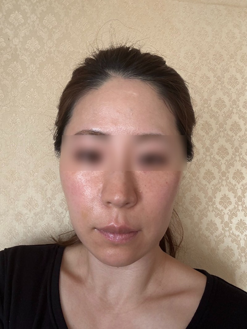 강남실리프팅전문 심부볼·중안부꺼짐은 왜 같이 보일까 실종류·디자인 차이 사진 5