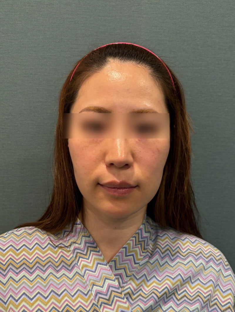 강남실리프팅전문 심부볼·중안부꺼짐은 왜 같이 보일까 실종류·디자인 차이 사진 4