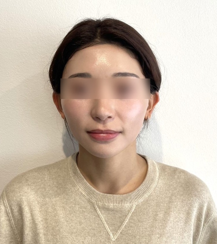 강남역 실리프팅 전문 땅콩형얼굴, 비포애프터만 보고 결정해도 될까? 붓기·멍 주의사항 사진 5