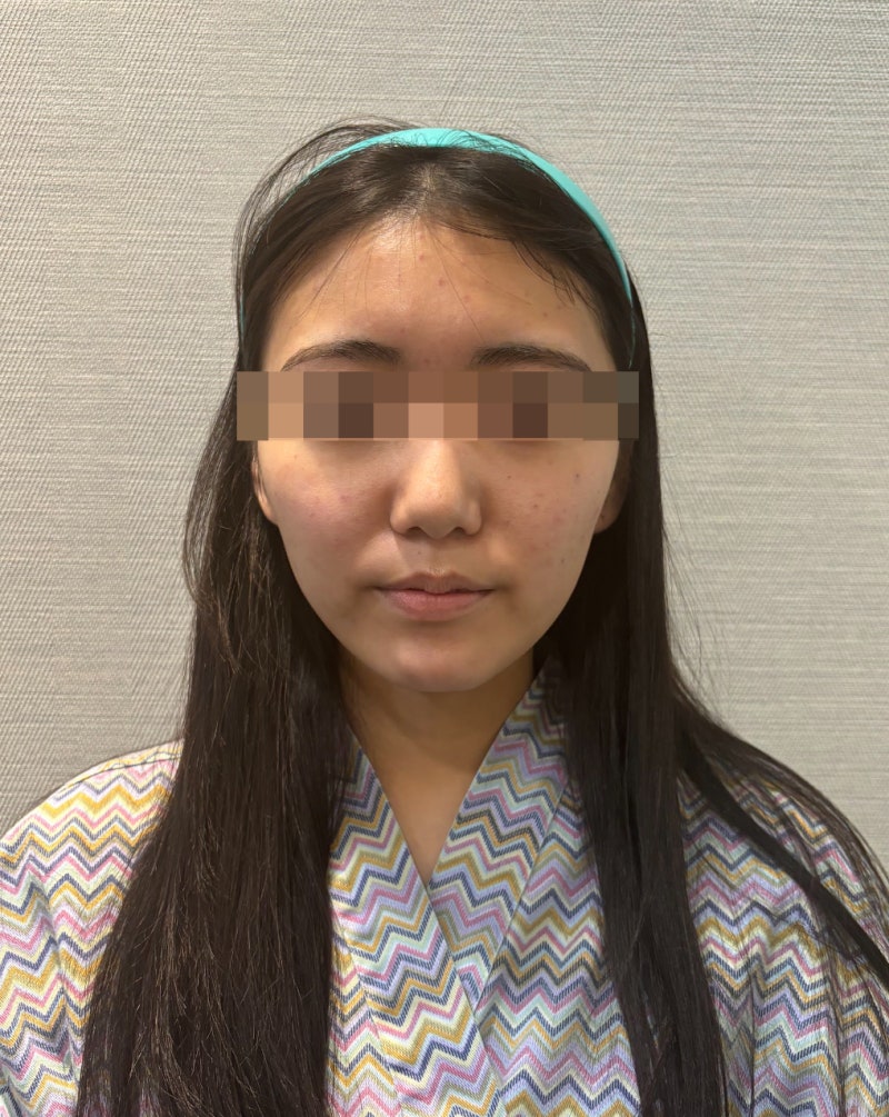 강남 실리프팅 추천, 녹는실로 턱선·윤곽·팔자주름 효과 진짜 있을까? 사진 5