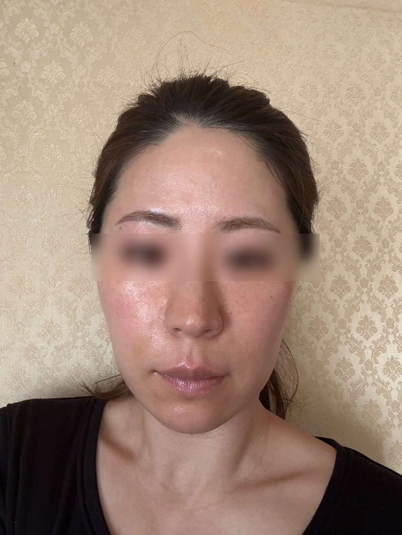 강남 실리프팅 잘하는 곳, 추천 많은 이유? 동안얼굴·중안부 진짜 짧아질까 사진 7