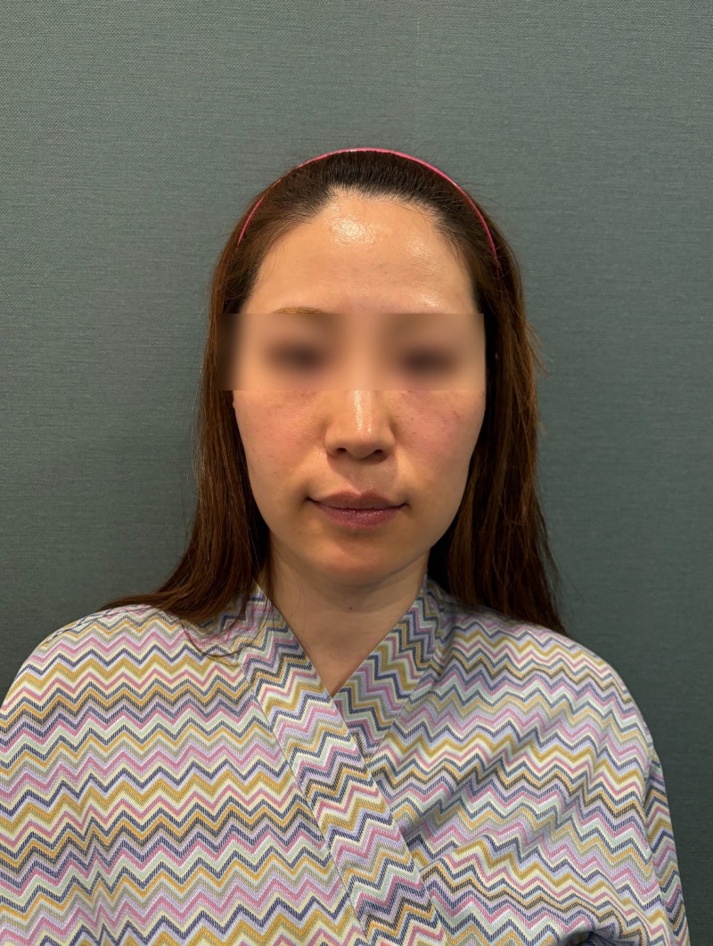 강남 실리프팅 잘하는 곳, 추천 많은 이유? 동안얼굴·중안부 진짜 짧아질까 사진 6