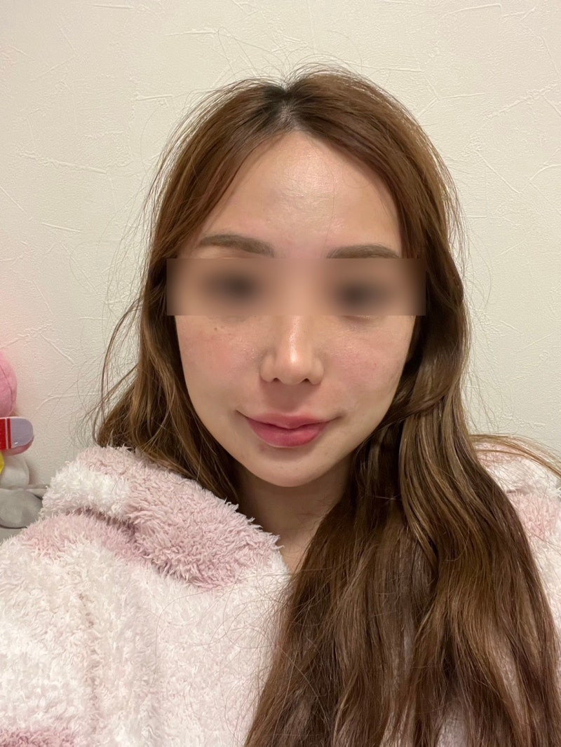 강남역 실리프팅 비교, 잘하는곳은 중안부·팔자주름·유지기간에서 갈립니다 사진 7