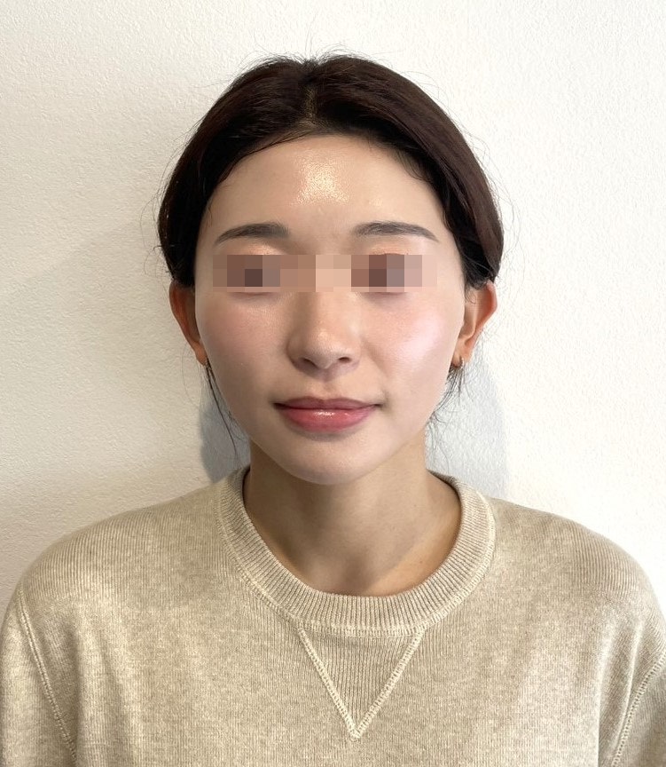 강남역 실리프팅 비교, 잘하는곳은 중안부·팔자주름·유지기간에서 갈립니다 사진 9