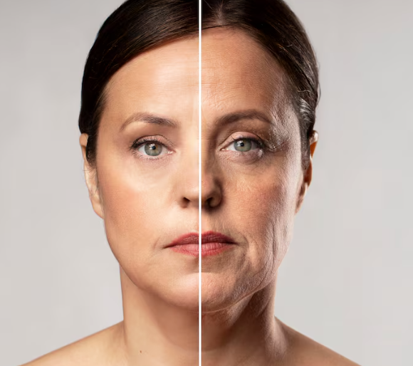 Thread Lift vs Filler untuk Usia 30-an, Apakah Sekarang Waktu yang Tepat? Kasus yang Membutuhkan Lifting 사진 2
