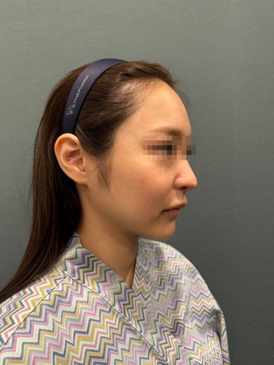 Seoul Thread Lift Reviews: Does It Really Work? Checking for Sagging, Wrinkles, and Contour Improvement 사진 7