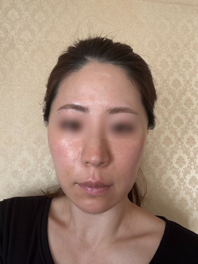 Why Do Gangnam Thread Lifts Vary? The Importance of Design, Facial Slimming Effects, Side Effects, and Aftercare 사진 9