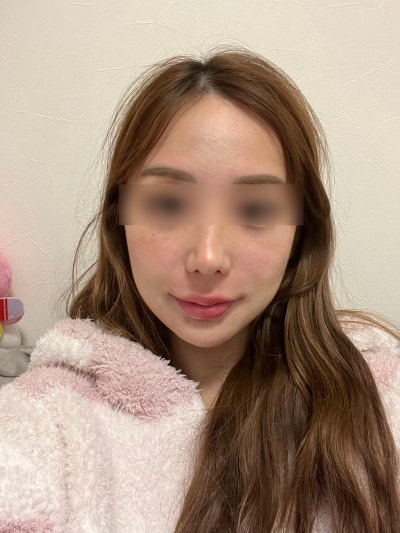 Kapan Deep Cheek Thread Lift dengan Benang Mint Gagal? Desain, Pilihan Jumlah Benang, dan Ulasan Nyata 사진 12