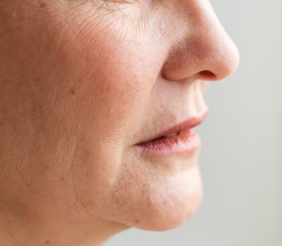 Kapan Deep Cheek Thread Lift dengan Benang Mint Gagal? Desain, Pilihan Jumlah Benang, dan Ulasan Nyata 사진 4
