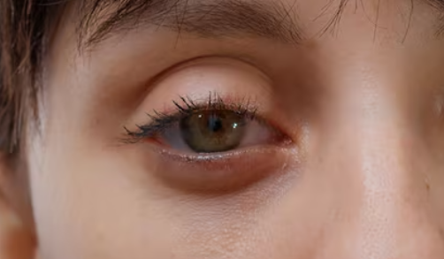 눈밑실리프팅 붓기 얼마나 갈까? 기간·부작용·통증·잘하는곳 기준