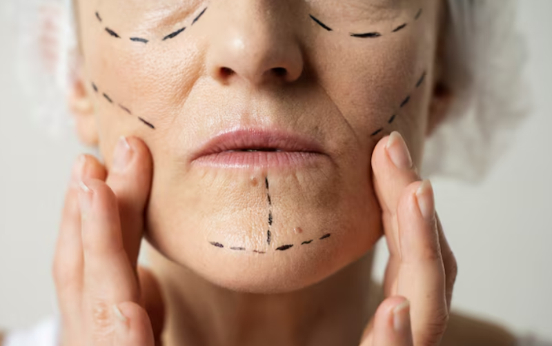Why Thread Lifts, Not Ultherapy, Are Needed for Sagging Cheeks: A Plastic Surgeon Explains