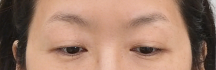 중년 눈처짐 수술 상안검과 눈썹거상 무엇이 다를까 비용 차이 설명 사진 4