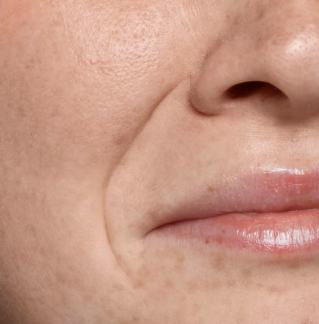 Can Deep Nasolabial Folds Be Improved with Thread Lifts? Differences from Fillers, Before-and-After Standards 사진 2