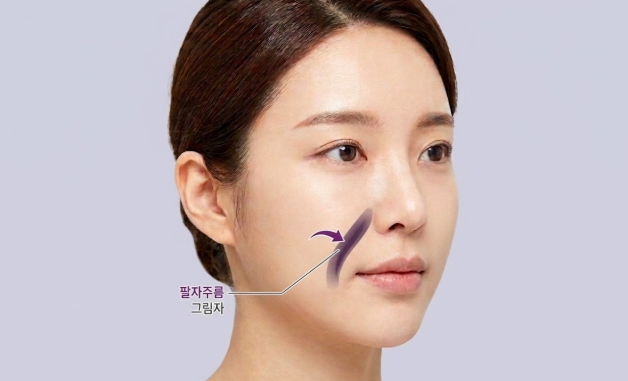Can Deep Nasolabial Folds Be Improved with Thread Lifts? Differences from Fillers, Before-and-After Standards 사진 5