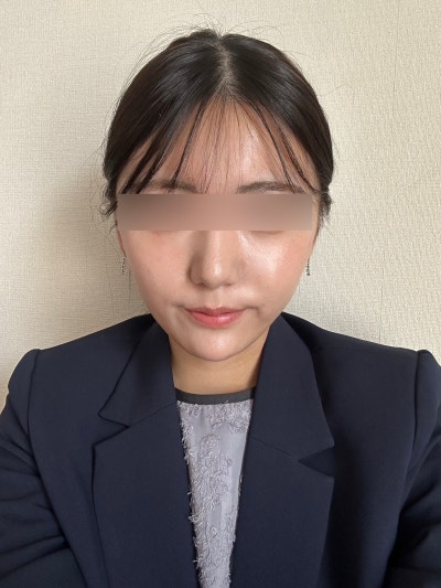 Silhouette Soft vs. Mint Thread: What's the Difference? Effects, Duration, Side Effects, and Suitable Facial Types 사진 7