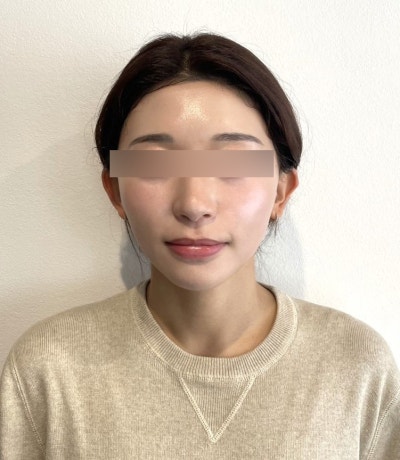 Silhouette Soft vs. Mint Thread: What's the Difference? Effects, Duration, Side Effects, and Suitable Facial Types 사진 9