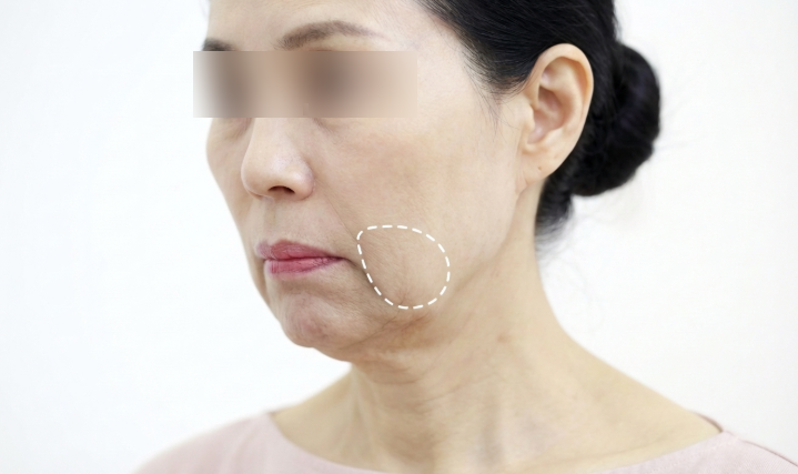 Prosedur Kerutan Marionette: Metode Mana yang Terbaik? Perbedaan Antara Filler, Thread Lift, dan Facelift 사진 5