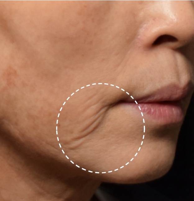 Prosedur Kerutan Marionette: Metode Mana yang Terbaik? Perbedaan Antara Filler, Thread Lift, dan Facelift 사진 2