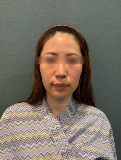 Prosedur Kerutan Marionette: Metode Mana yang Terbaik? Perbedaan Antara Filler, Thread Lift, dan Facelift 사진 13