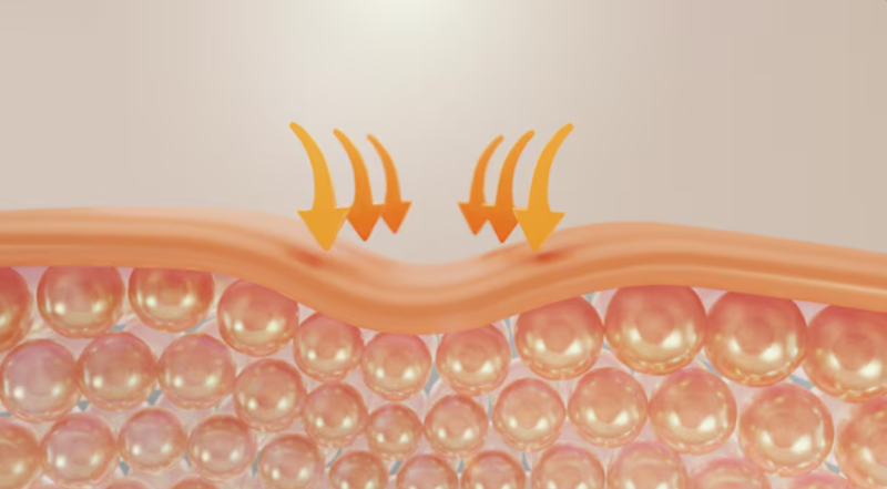 Before Looking for Cheongdam Thread Lift Reviews: Understand Thread Lift Effects and Duration 사진 11