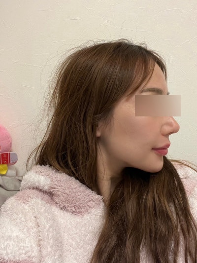 Seberapa Berbeda Efek Thread Lift Lipatan Nasolabial? Penjelasan Perubahan Lifting Midface yang Kendur 사진 3